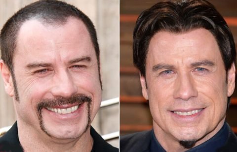 Best Celebrity Facelifts Before and After
