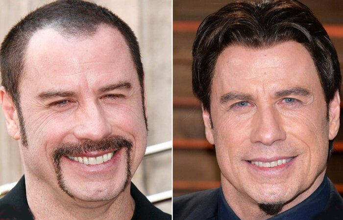 Celebrity Face Lifts Before And After 60 Photos Moonagedaydream film