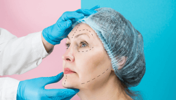 subperiosteal facelift