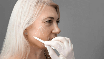 subperiosteal facelift surgery