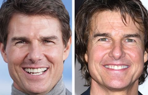 Best Celebrity Facelifts Before and After