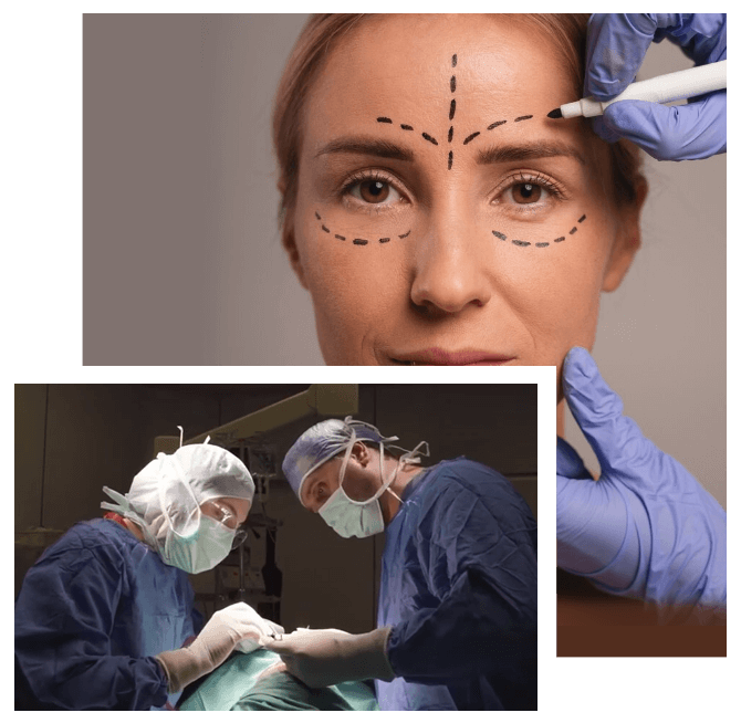 what is a subperiosteal facelift