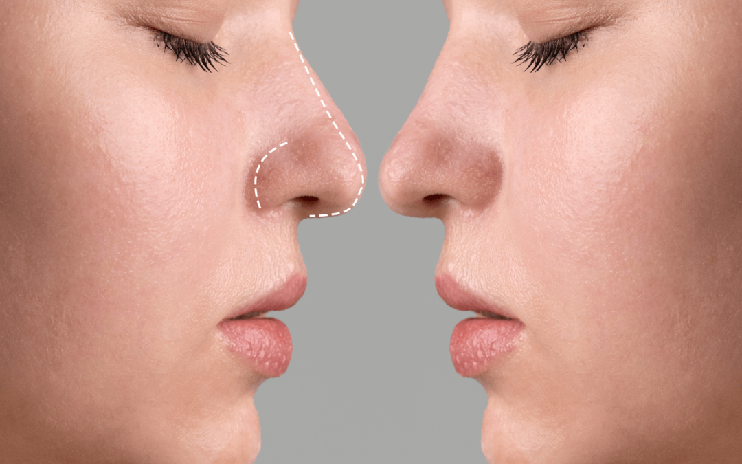 How Do I Know My Rhinoplasty Won’t Be Botched?