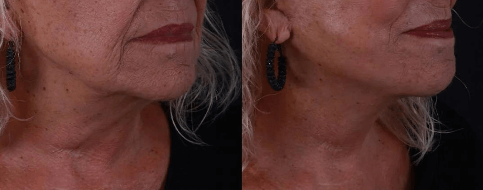 tightness after neck lift