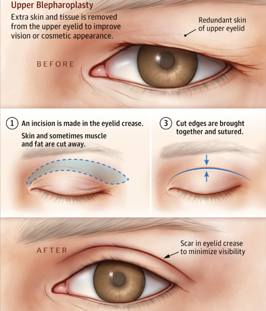 saggy-eyelid-surgery-turkey 