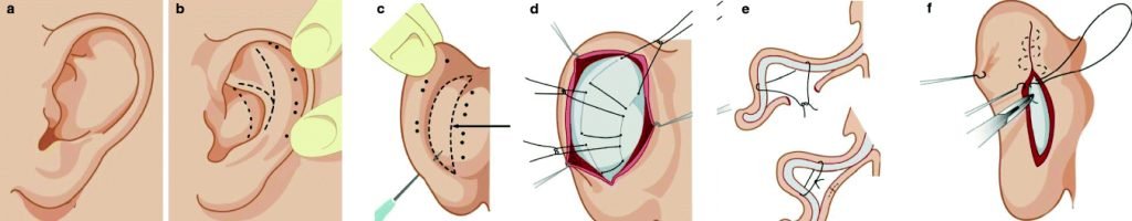 what-is-the-healing-process-after-otoplasty-surgery