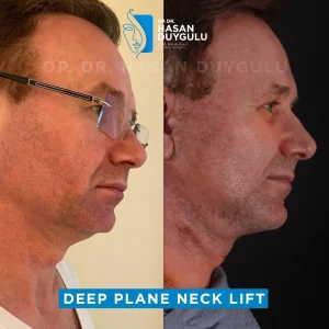 male-deep-plane-face-lift-istanbul-images