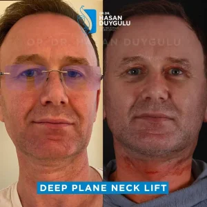 male-deep-plane-face-lift-turkey-images