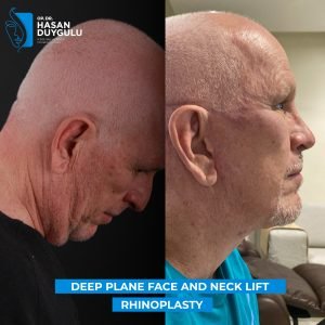 male-face-and-neck-lift-turkey-photos