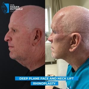 male-facelift-photos-turkey