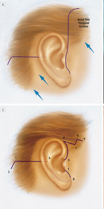 How Visible Are Facelift Incision Lines and Scars?