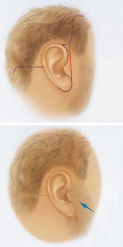 How Visible Are Facelift Incision Lines and Scars?