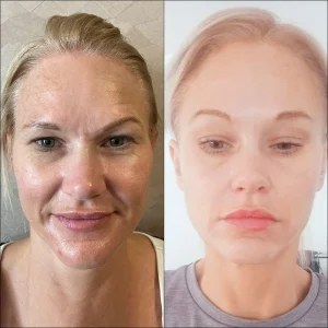 fox-eye-before-after-images-in-turkey