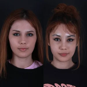 fox-eye-before-after-in-turkey-istanbul