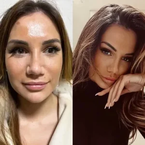 fox-eye-before-after-photos-in-turkey