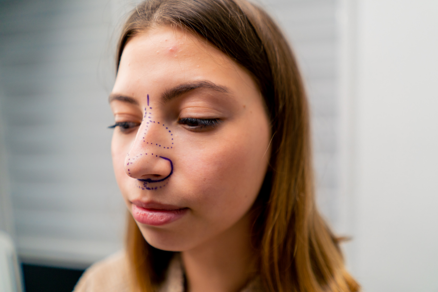Bulbous Nose Rhinoplasty Turkey