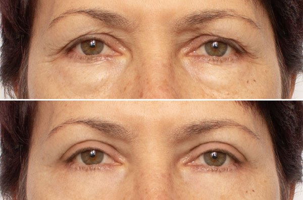 how-visible-are-blepharoplasty-incision-lines-and-scars