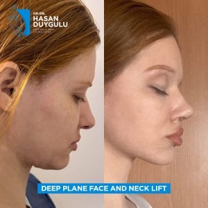 Facelift Before After Photos in Turkey