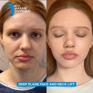 Facelift Before After Photos in Turkey