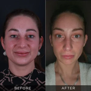 Fox Eyes Before After Photos in Turkey