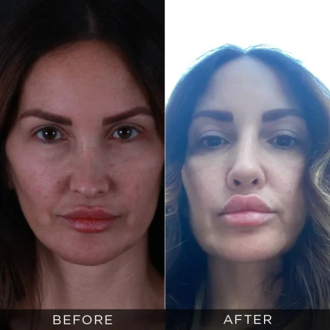 revision-rhinoplasty-before-after-20-optimized