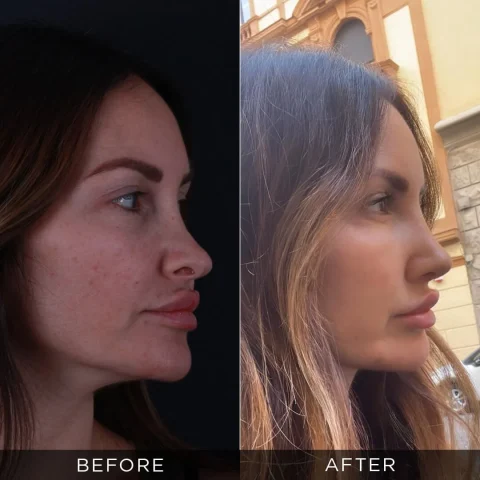 revision-rhinoplasty-before-after-21-optimized