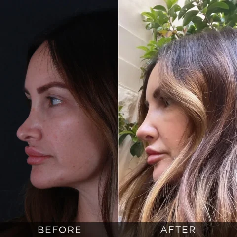 revision-rhinoplasty-before-after-22-optimized