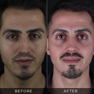 revision-rhinoplasty-before-and-after-12-optimized