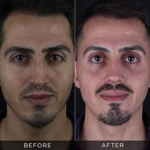 revision-rhinoplasty-before-and-after-12-optimized