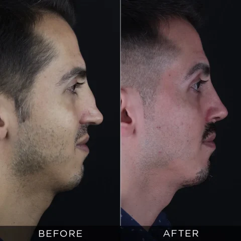 revision-rhinoplasty-before-and-after-13-optimized