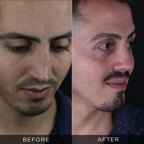 revision-rhinoplasty-before-and-after-14-optimized