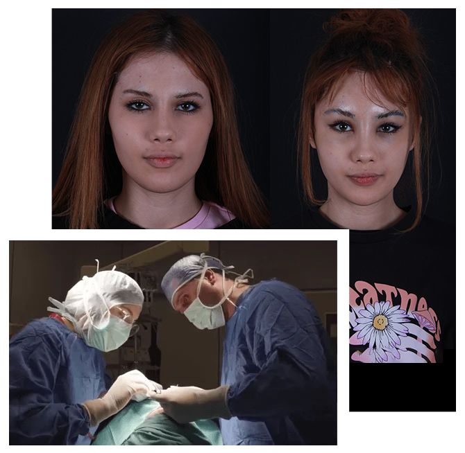 Blepharoplasty (Eyelid Surgery)