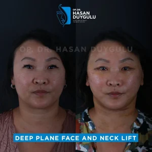 Neck Lift Turkey Gallery & Before and After Photos