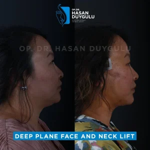 Neck Lift Turkey Gallery & Before and After Photos
