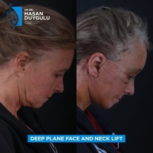 Facelift Before After Photos in Turkey