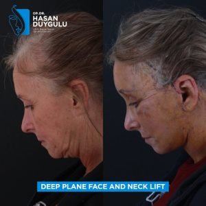 Facelift Before After Photos in Turkey