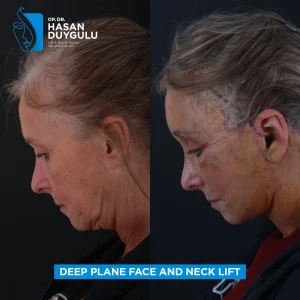 Neck Lift Turkey Gallery & Before and After Photos