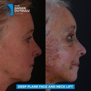 Facelift Before After Photos in Turkey