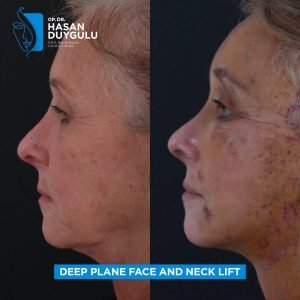 Facelift Before After Photos in Turkey