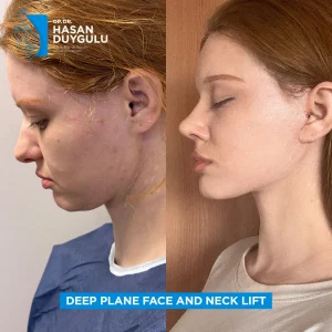 Facelift Before After Photos in Turkey