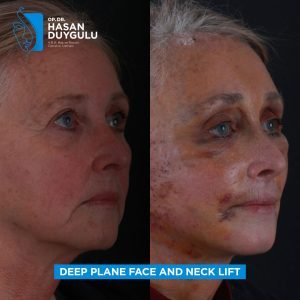 Facelift Before After Photos in Turkey