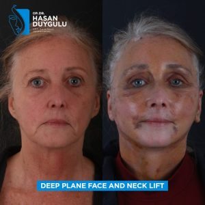 Facelift Before After Photos in Turkey
