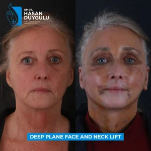 Neck Lift Turkey Gallery & Before and After Photos