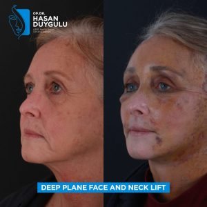 Facelift Before After Photos in Turkey