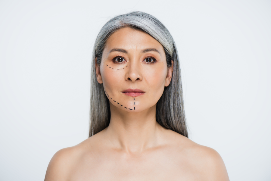 When Are Stitches Removed After Facelift Surgery?