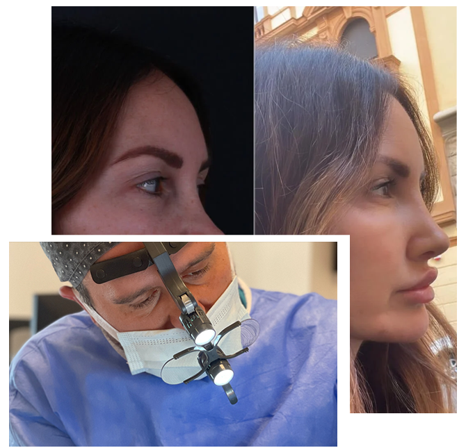 Revision Rhinoplasty in Turkey Revision Rhinoplasty in Turkey