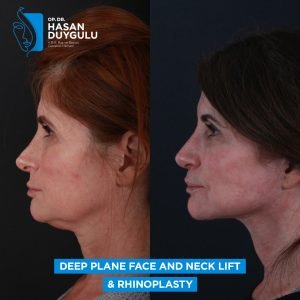women deep plane face lift