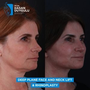 Deep plane face and neck lift
