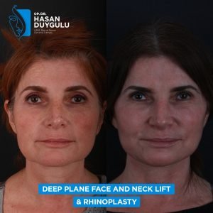 rhinoplasty before after woman