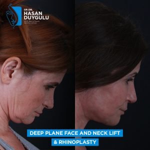 female neck lift before after